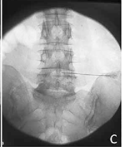 Spinal needle inserted in interdiscal space image 3