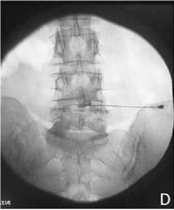 Spinal needle inserted in interdiscal space image 4