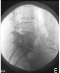 Spinal needle inserted in interdiscal space image 5